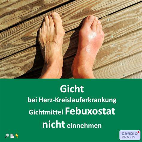 Schmerzverlauf beim akuten Gichtanfall