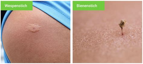 Soforthilfe Wespenstich: Kühlen und Beobachtung