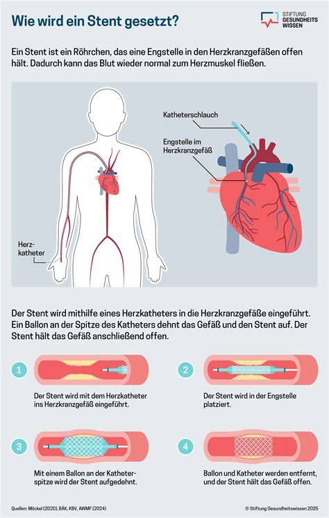 Stent und Bypass als Behandlungsmethoden am Herzen