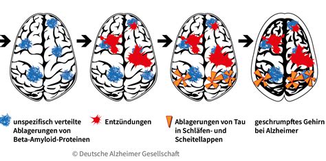 Symbolische Darstellung eines Bücherregals als Metapher für das Gehirn bei Alzheimer