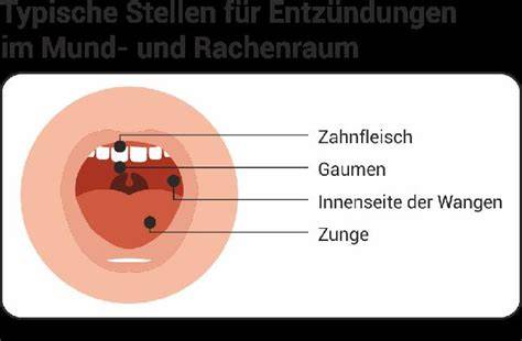 Tipps zur Vorbeugung von Verbrennungen am Gaumen