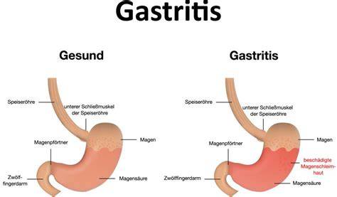 Typen der Gastritis und Zusammenhang mit Honig