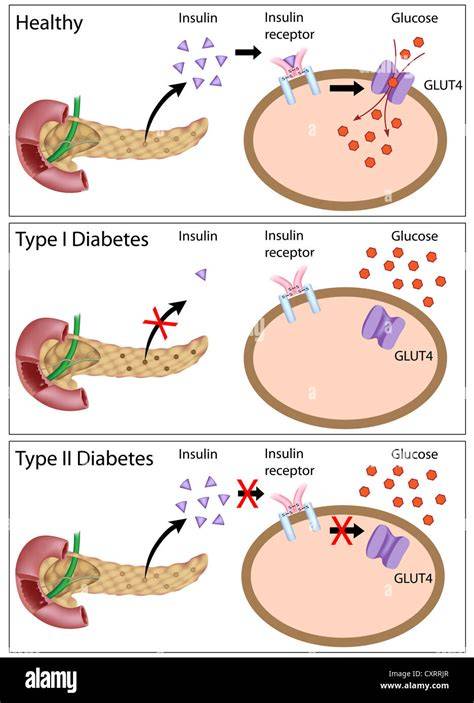 Unterschiede Diabetes Typ 1 und Typ 2 Schema