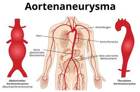 Ursachen und Symptome von Aorten-Aneurysmen und -Dissektionen