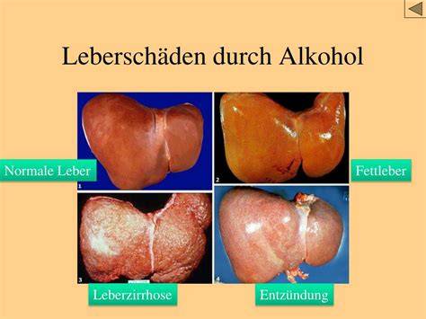 Vergleich Zucker und Alkohol für die Leber