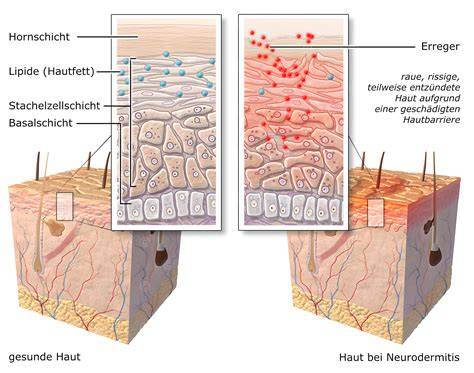 Vergleichsbild gesunde Haut vs. diabetisch geschädigte Haut