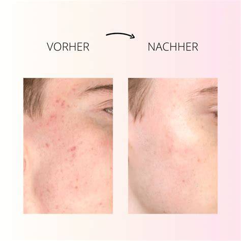 Vorher-Nachher: Wirkung der Heilkreide-Honig-Maske auf das Hautbild