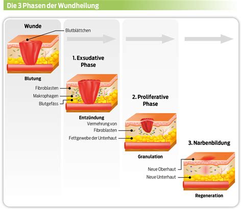 Vorher-Nachher: Wundheilung mit ManukaLind (schematisch)