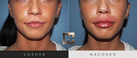 Vorher-Nachher Lippen mit Black Honey