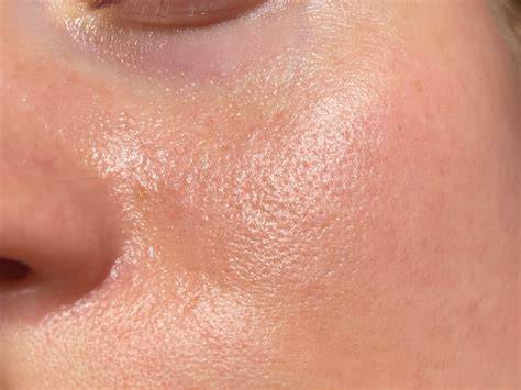 Vorher-Nachher-Bild: Hautbild vor und nach Salz-Honig-Peeling