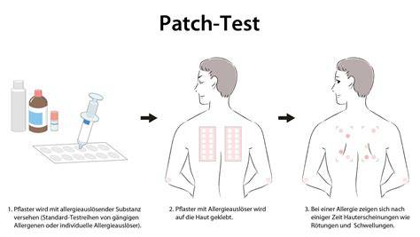 Warnhinweis Allergie-Test Patch-Test mit Honig