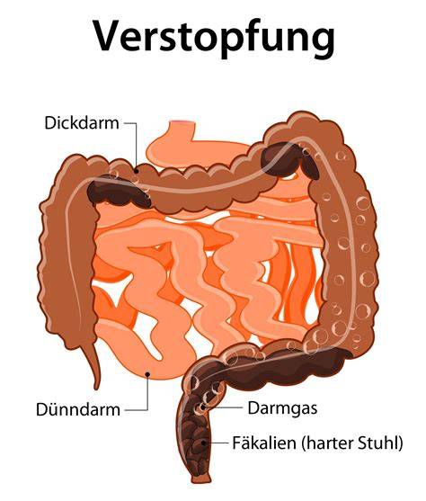 Warnhinweis bei ernster Verstopfung: Symptome und ärztlicher Rat