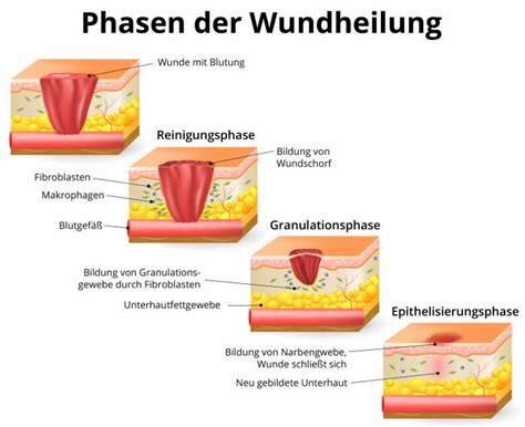 Wundheilungsprozess mit Medihoney: von der Reinigung zur Heilung