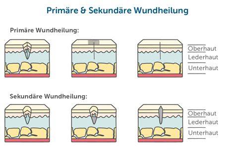 Wundversorgung mit Manuka-Honig (schematisch)