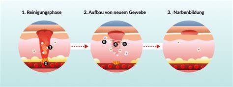 Zuckerpaste auf einer Wunde - schematische Darstellung