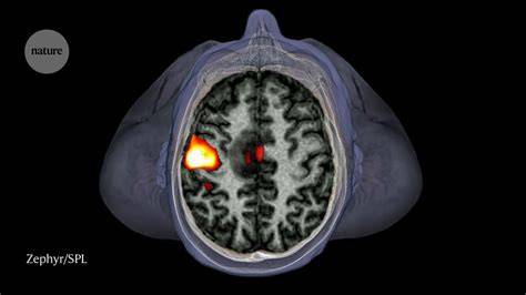 fMRI-Scan: Gehirnaktivierung bei Zuckerkonsum